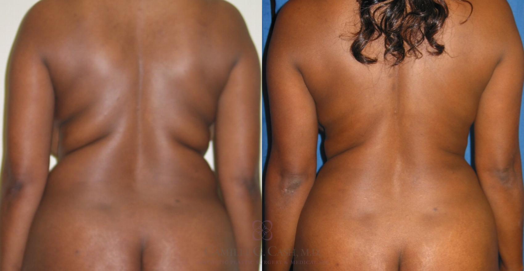 Before & After Mommy Makeover Case 134 View #3 View in Houston, TX
