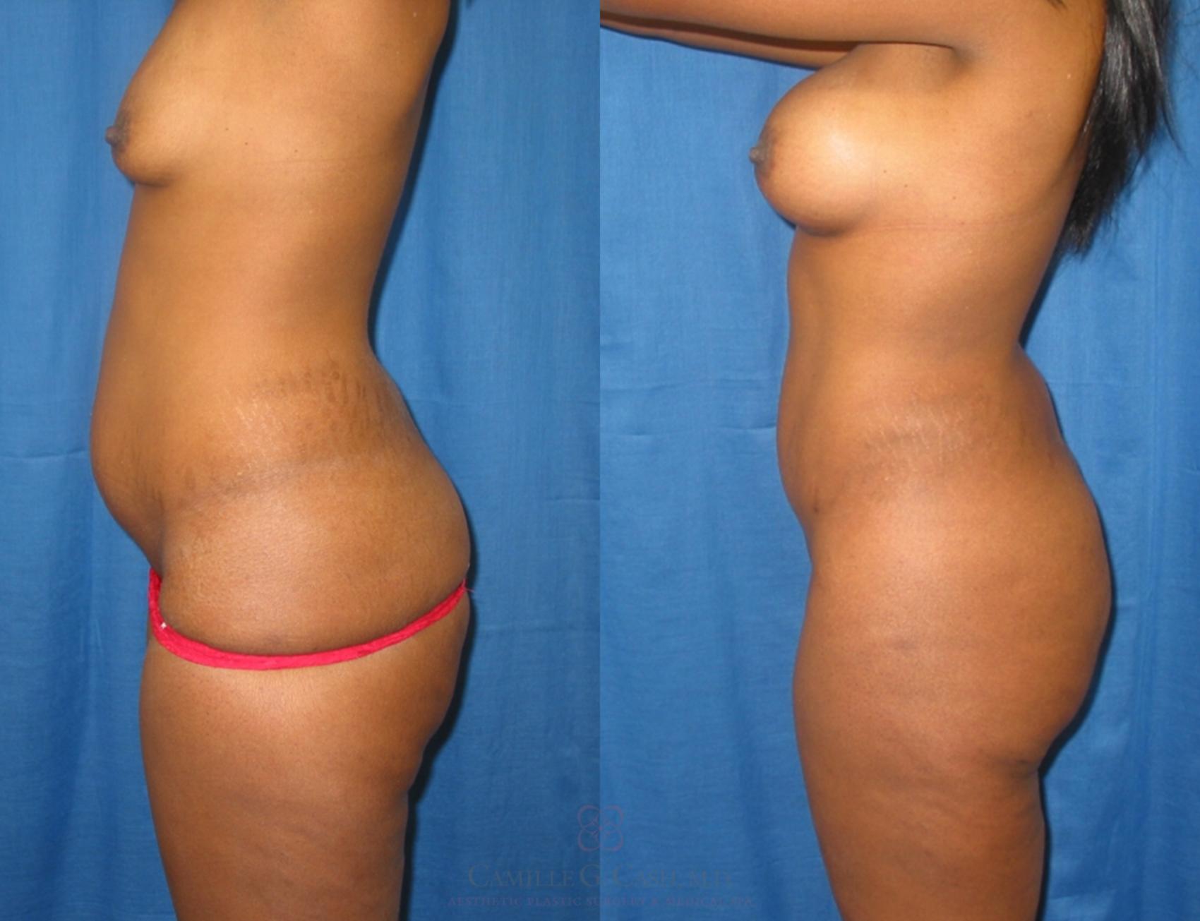 Before & After Mommy Makeover Case 137 View #2 View in Houston, TX