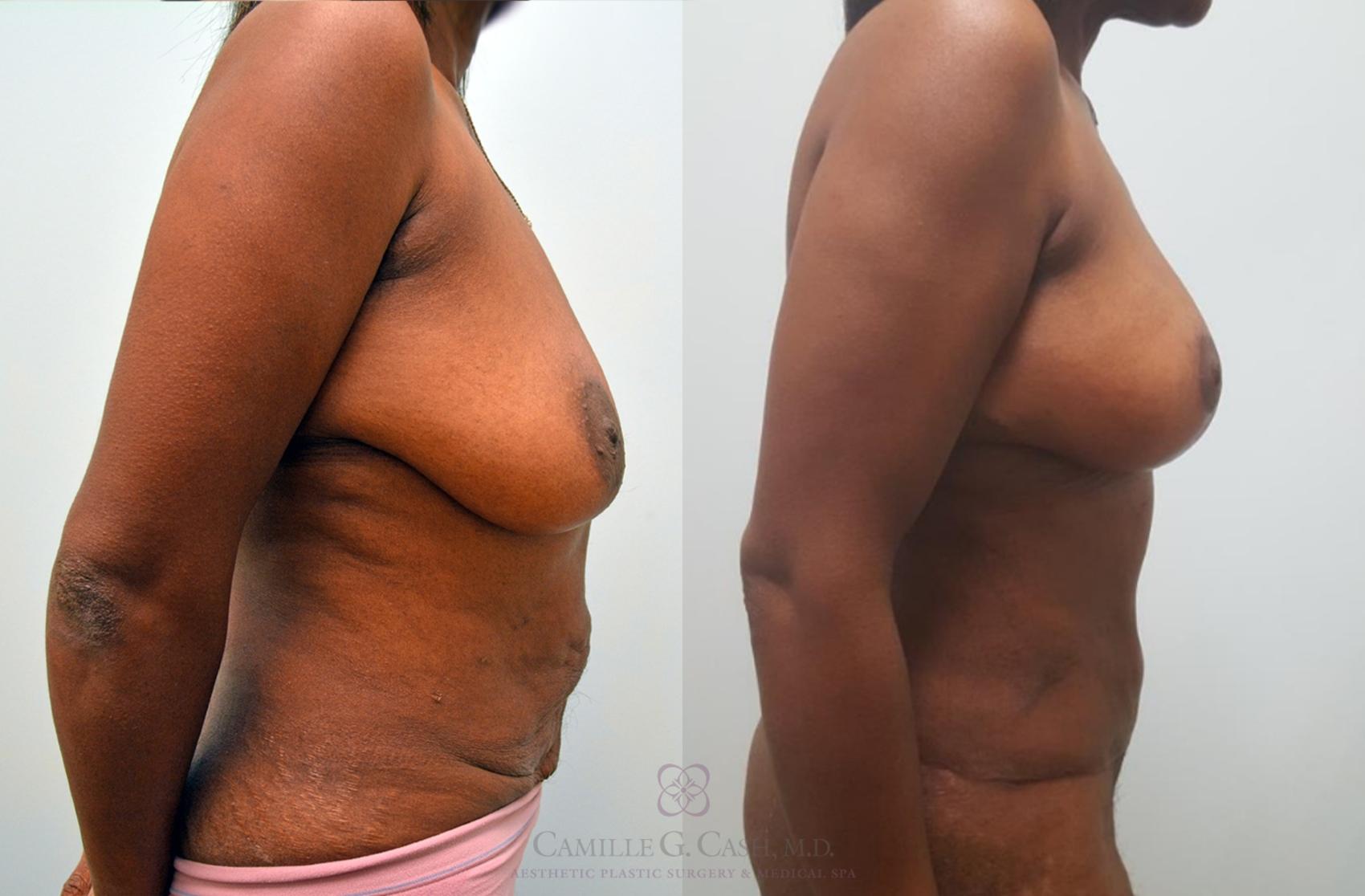 Before & After Mommy Makeover Case 148 Left Side View in Houston, TX