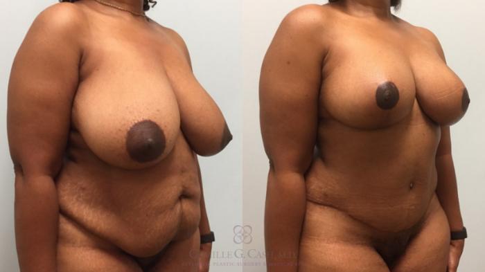 Before & After Mommy Makeover Case 215 Right Oblique View in Houston, TX