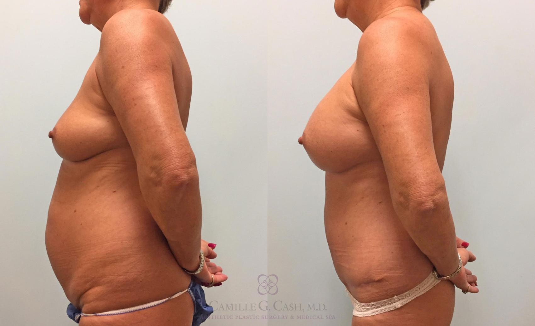 Before & After Mommy Makeover Case 219 View #4 View in Houston, TX