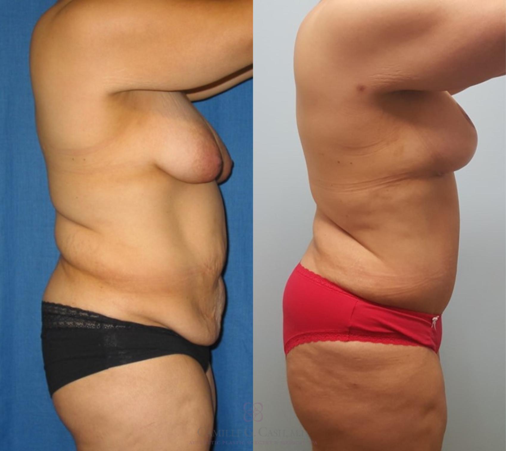Before & After Mommy Makeover Case 228 View #7 View in Houston, TX