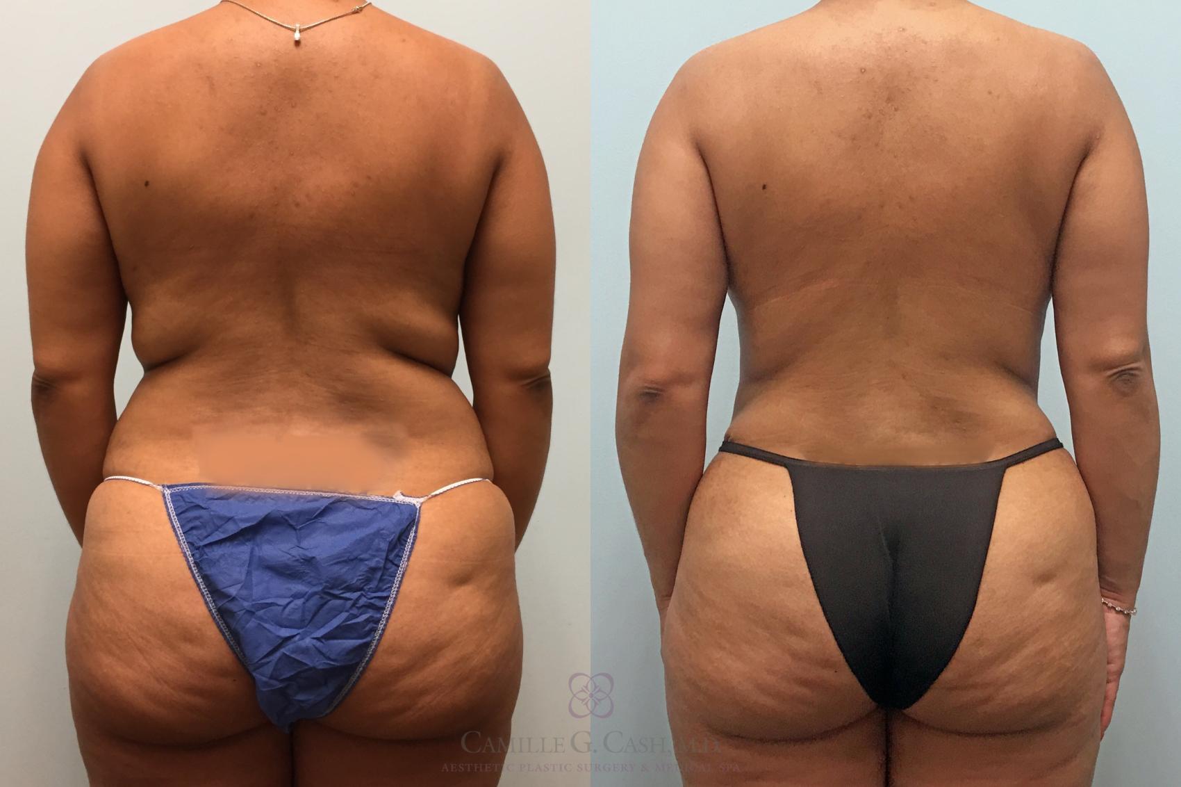 Before & After Mommy Makeover Case 255 Back View in Houston, TX