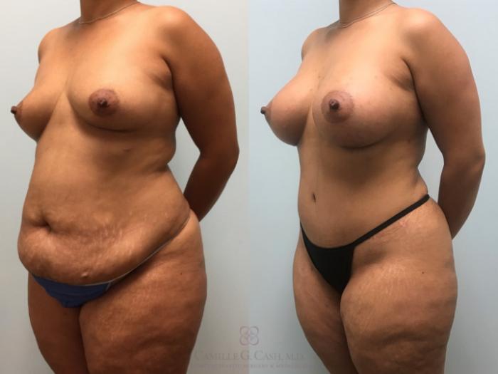 Before & After Mommy Makeover Case 255 Left Oblique View in Houston, TX