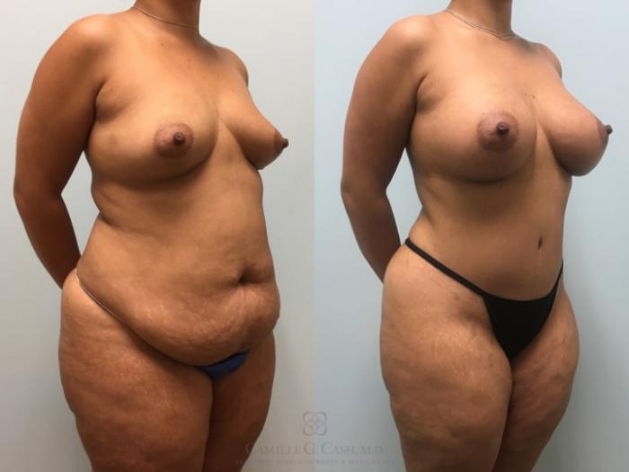 Before & After Mommy Makeover Case 255 Right Oblique View in Houston, TX