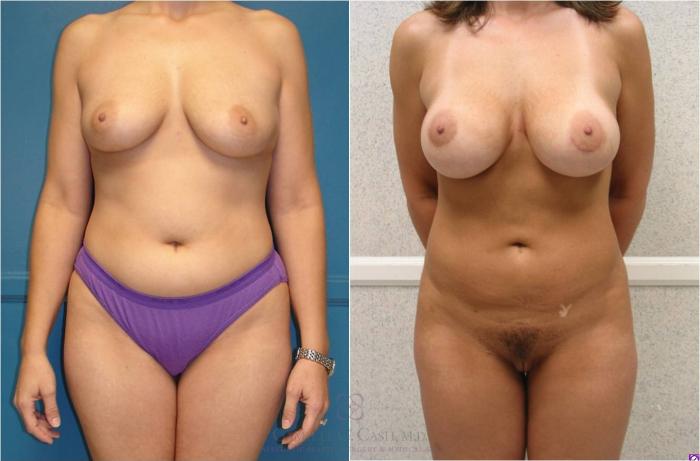 Before & After Liposuction Case 26 View #1 View in Houston, TX