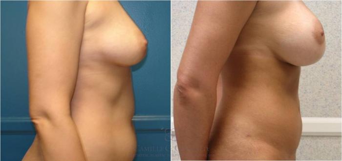 Before & After Breast Augmentation Case 26 View #3 View in Houston, TX