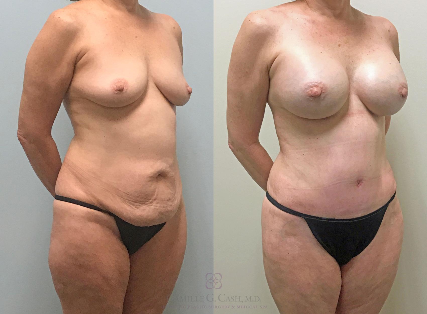 Before & After Mommy Makeover Case 290 View #4 View in Houston, TX