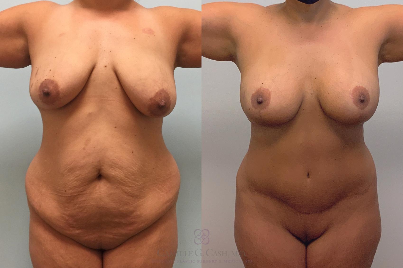 Before & After Mommy Makeover Case 393 front 3 years View in Houston, TX