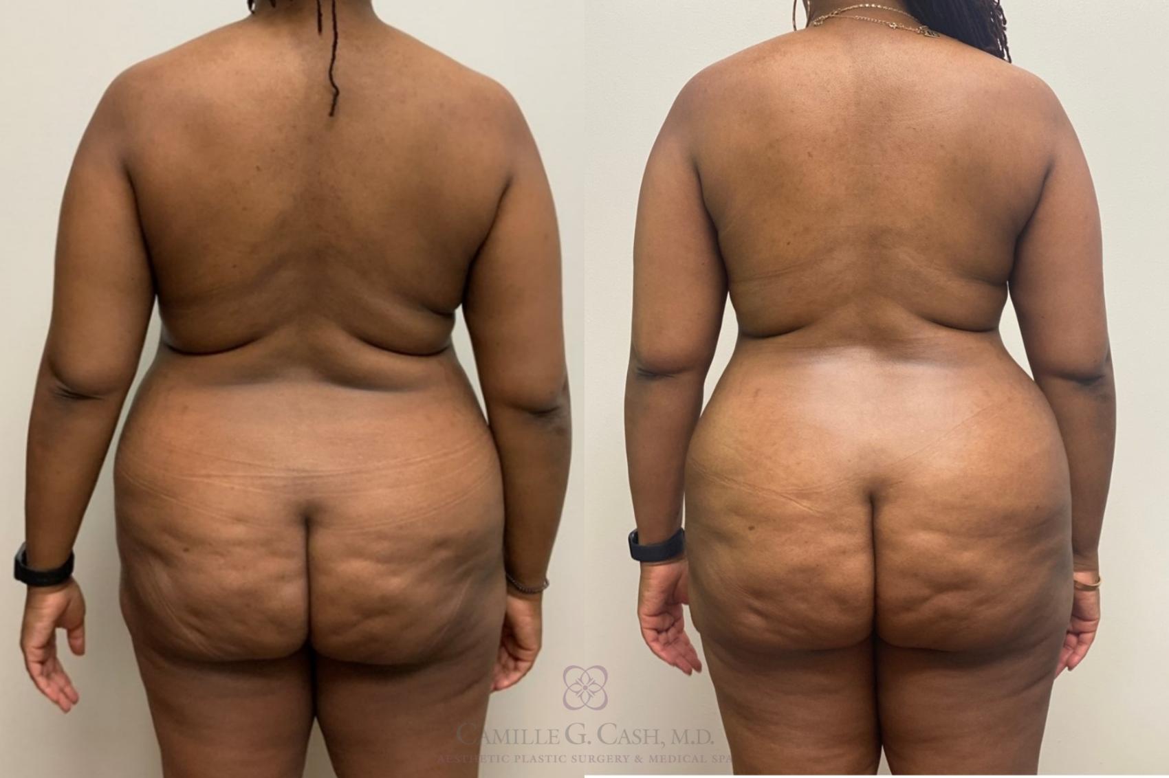 Before & After Mommy Makeover Case 449 Back View in Houston, TX