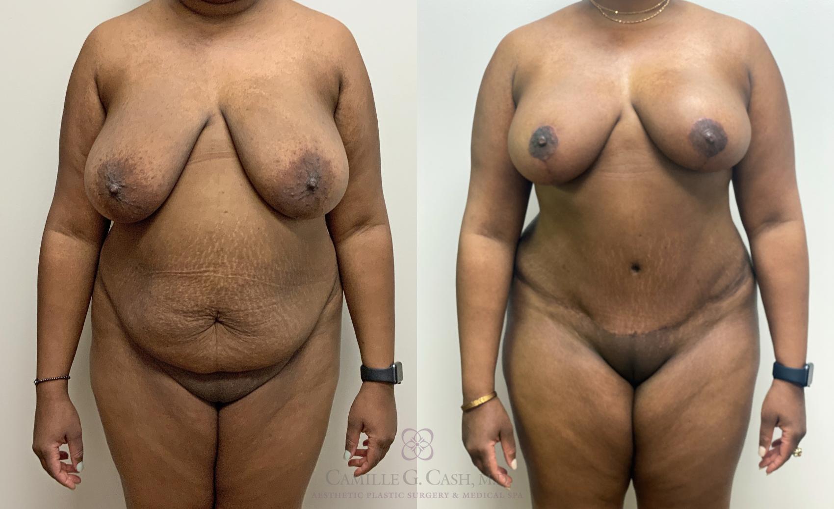 Before & After Mommy Makeover Case 449 Front 5 months View in Houston, TX