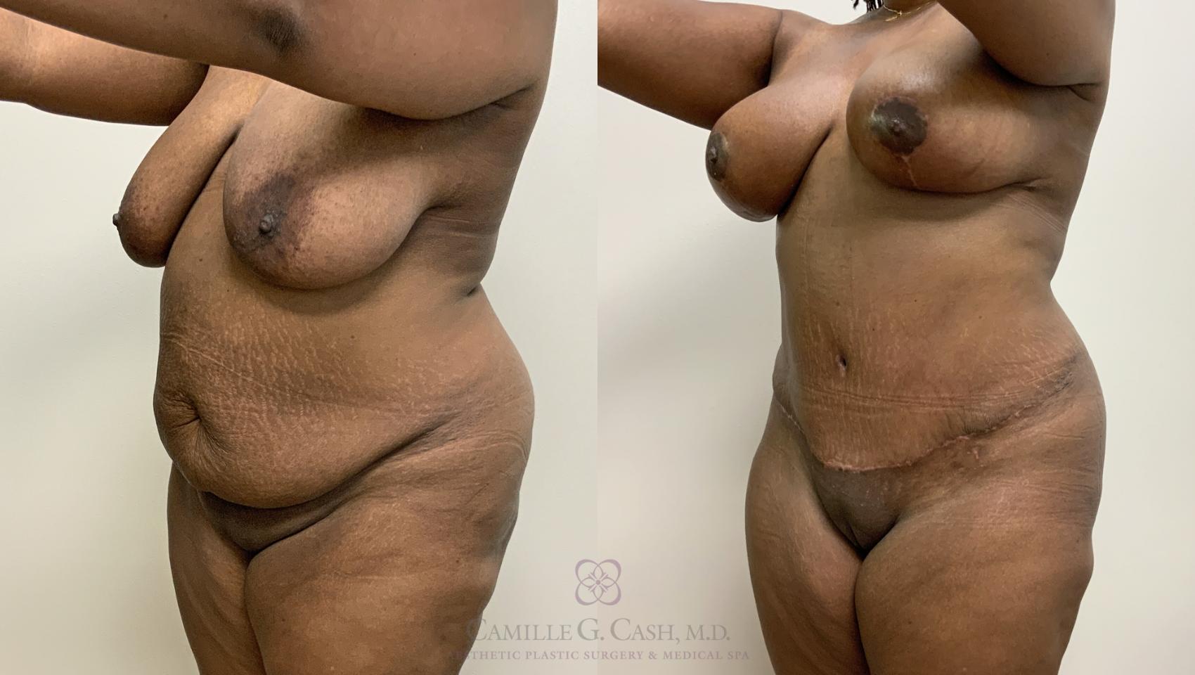 Before and after a tummy tuck, liposuction, and breast reduction