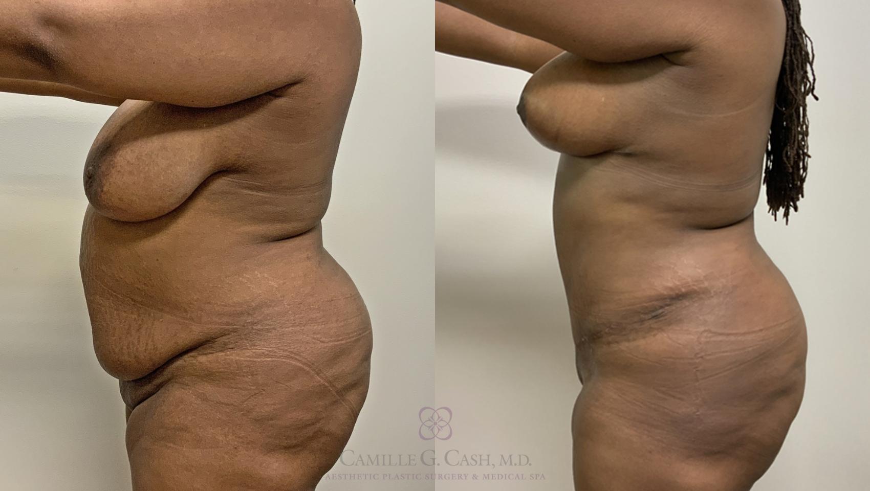 Before and after a tummy tuck, liposuction, and breast reduction