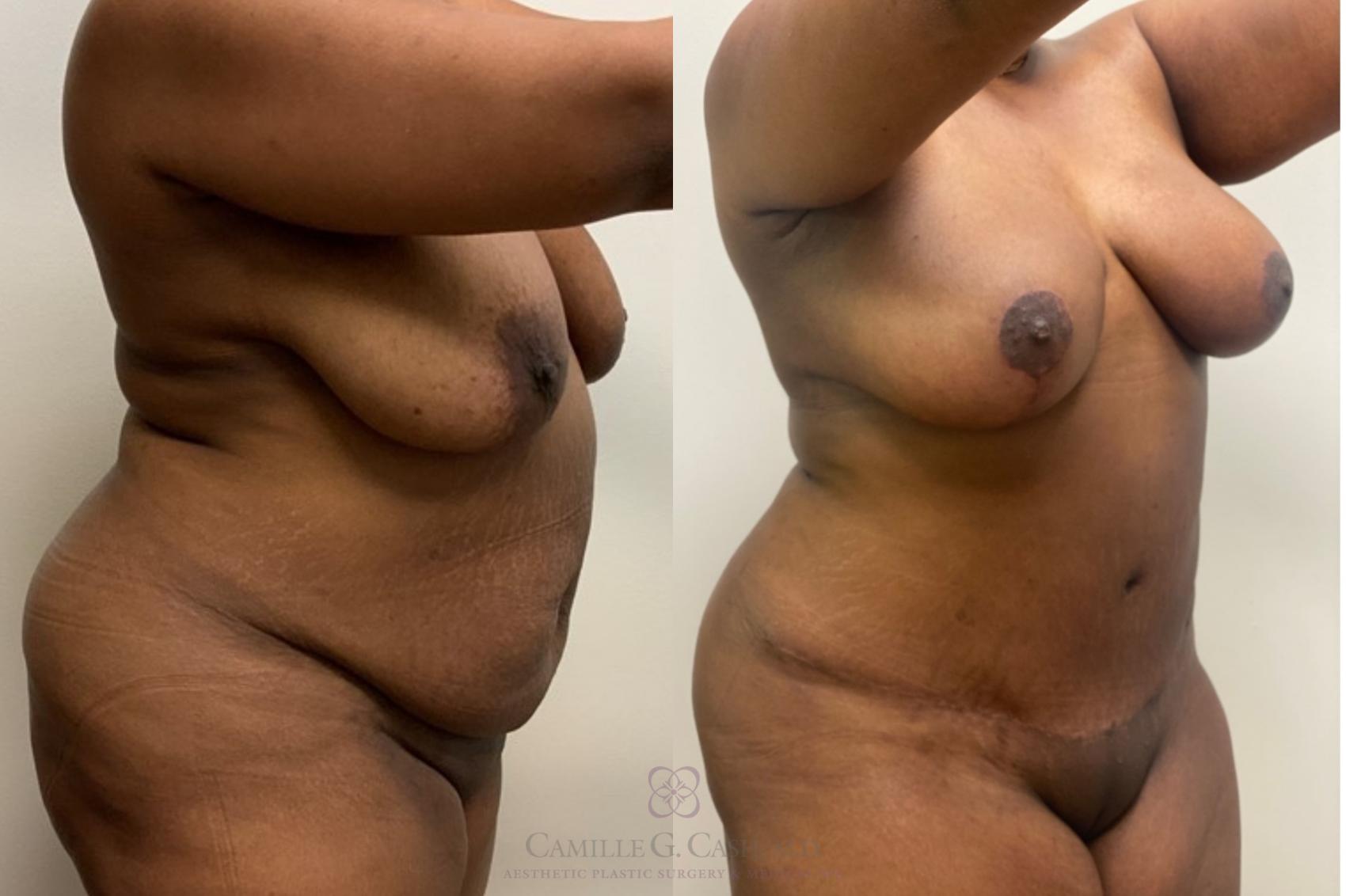 Before & After Mommy Makeover Case 449 Right Oblique View in Houston, TX