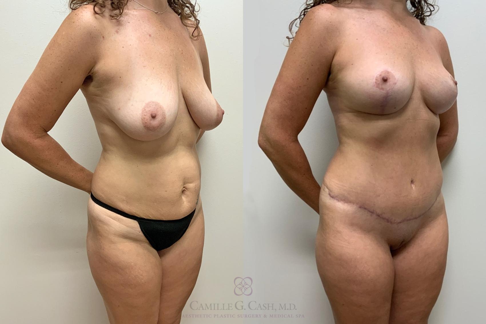 Before & After Mommy Makeover Case 452 Left Oblique View in Houston, TX