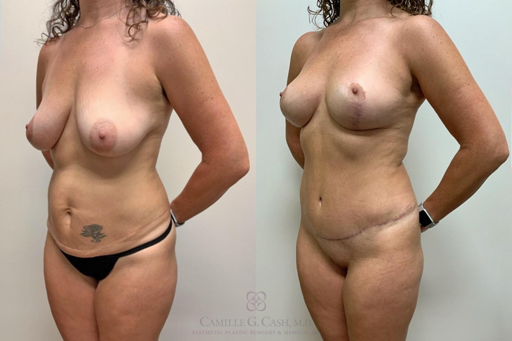 Before & After Mommy Makeover Case 452 Right Oblique View in Houston, TX