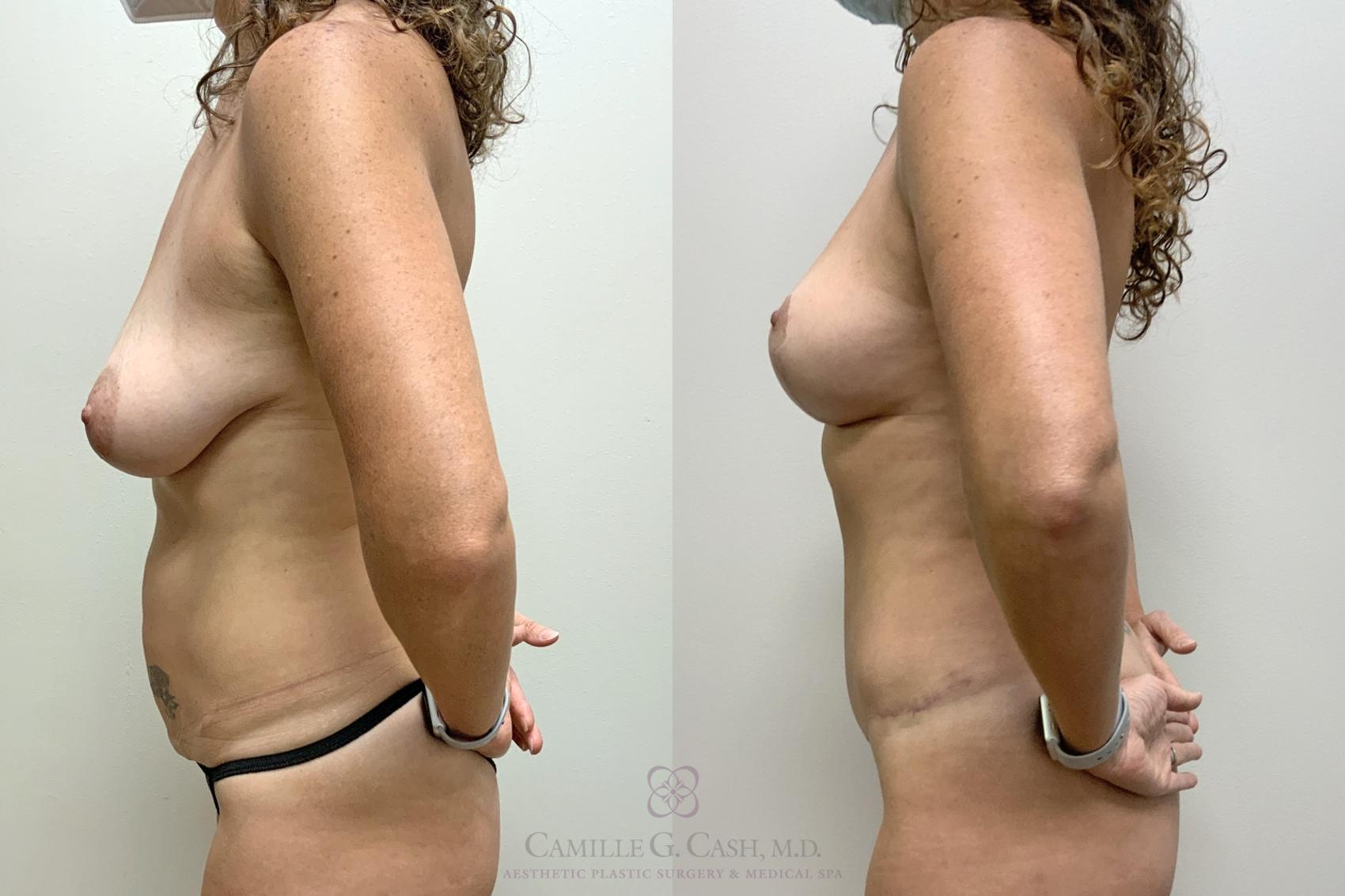 Before & After Mommy Makeover Case 452 Right Side View in Houston, TX