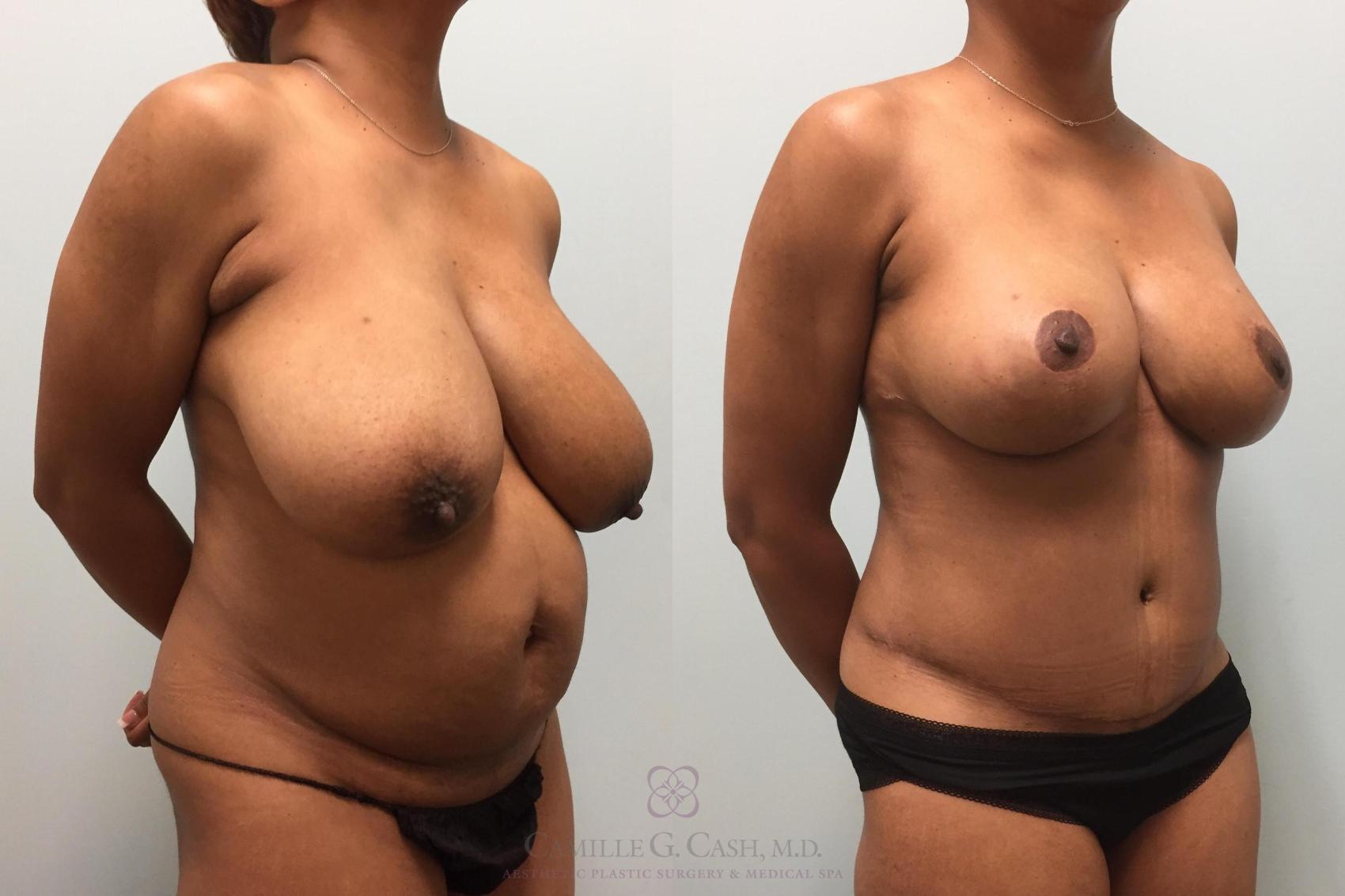 Before & After Mommy Makeover Case 463 Left Oblique View in Houston, TX