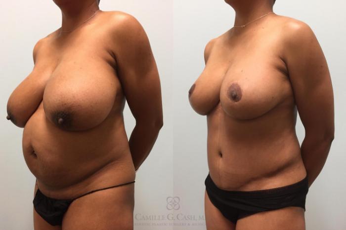 Before & After Mommy Makeover Case 463 Right Oblique View in Houston, TX
