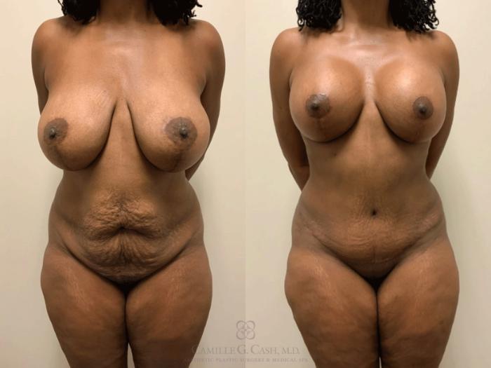 Before & After Tummy Tuck With Hernia Repair Case 475 Front View in Houston, TX