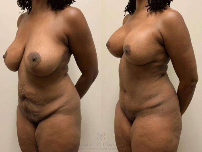 Before & After Tummy Tuck With Hernia Repair Case 475 Left Oblique View in Houston, TX