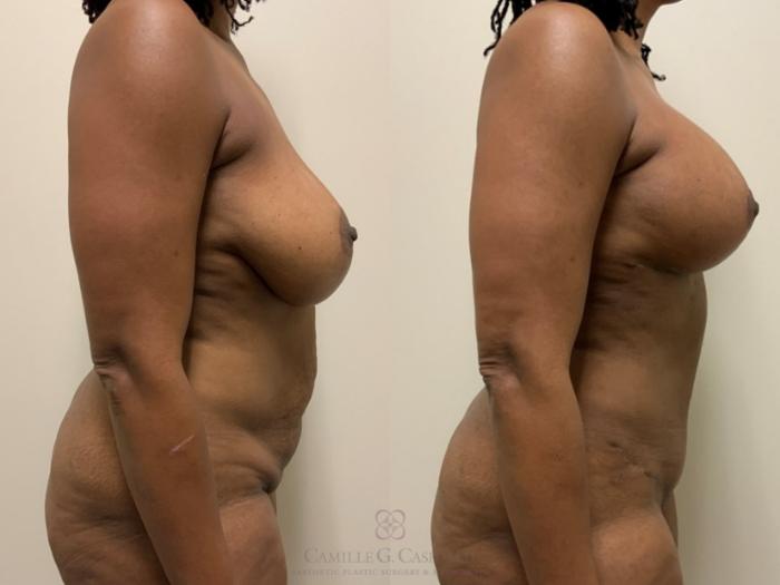 Before & After Tummy Tuck With Hernia Repair Case 475 Left Side View in Houston, TX