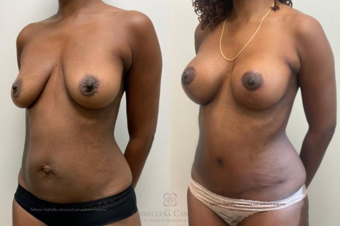 Before & After Mommy Makeover Case 477 Left Oblique View in Houston, TX