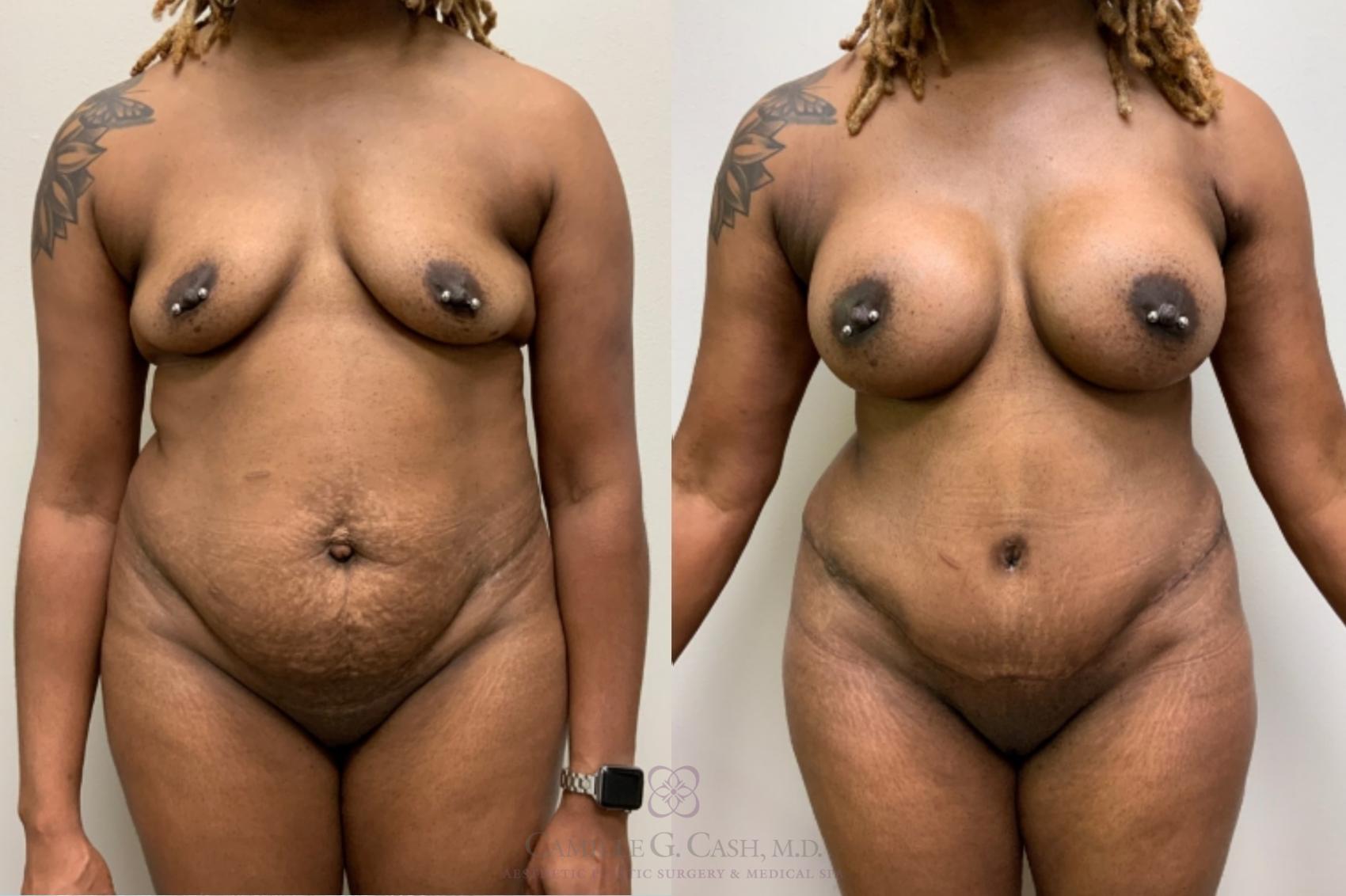 Before & After Mommy Makeover Case 484 front 3 View in Houston, TX