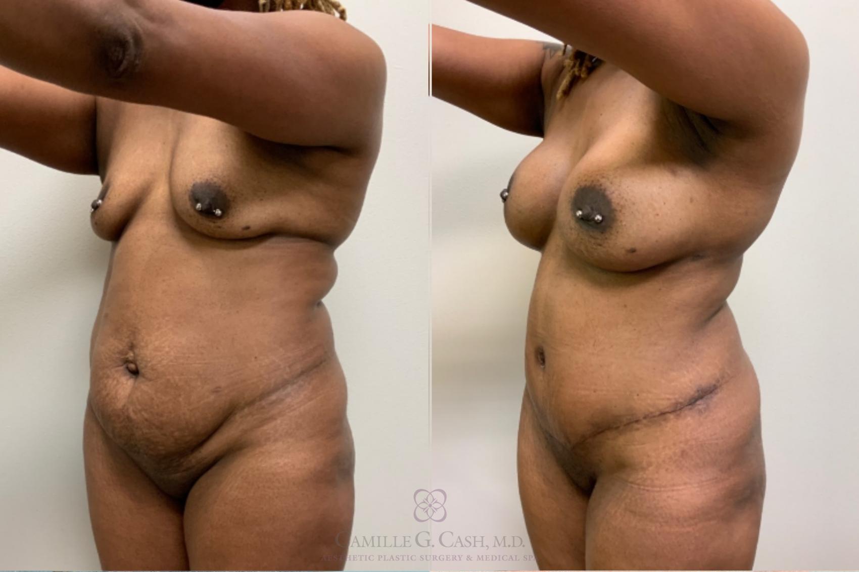 Before & After Mommy Makeover Case 484 r ob 3 View in Houston, TX