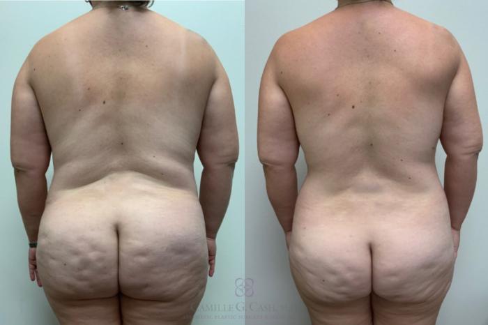 Before & After Tummy Tuck With Hernia Repair Case 498 Back View in Houston, TX