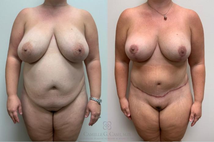Before & After Tummy Tuck With Hernia Repair Case 498 front 11 View in Houston, TX
