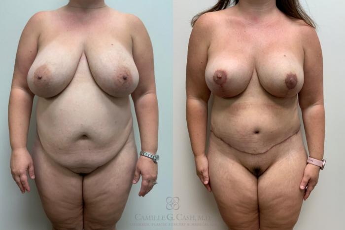 Before & After Tummy Tuck With Hernia Repair Case 498 Front View in Houston, TX