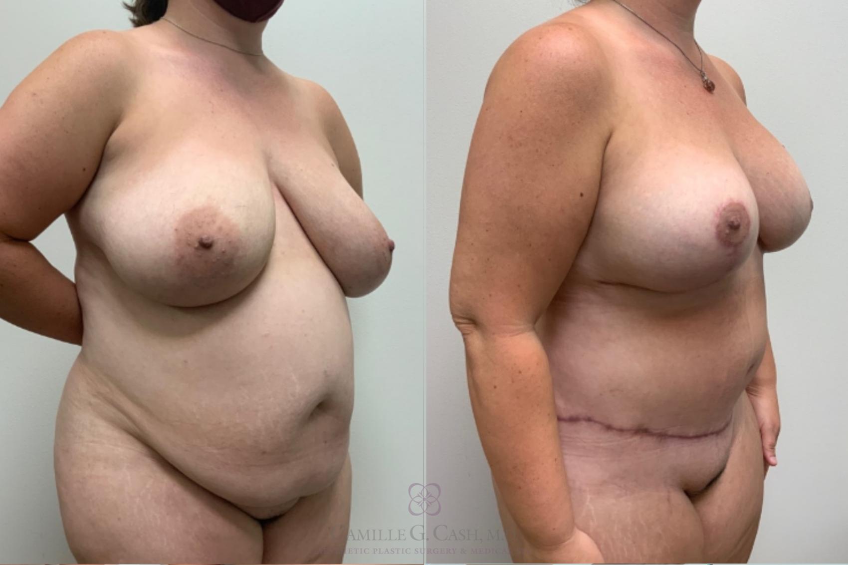 Before & After Mommy Makeover Case 498 Left Oblique View in Houston, TX