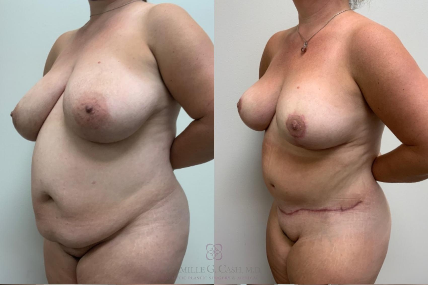 Before & After Mommy Makeover Case 498 Right Oblique View in Houston, TX