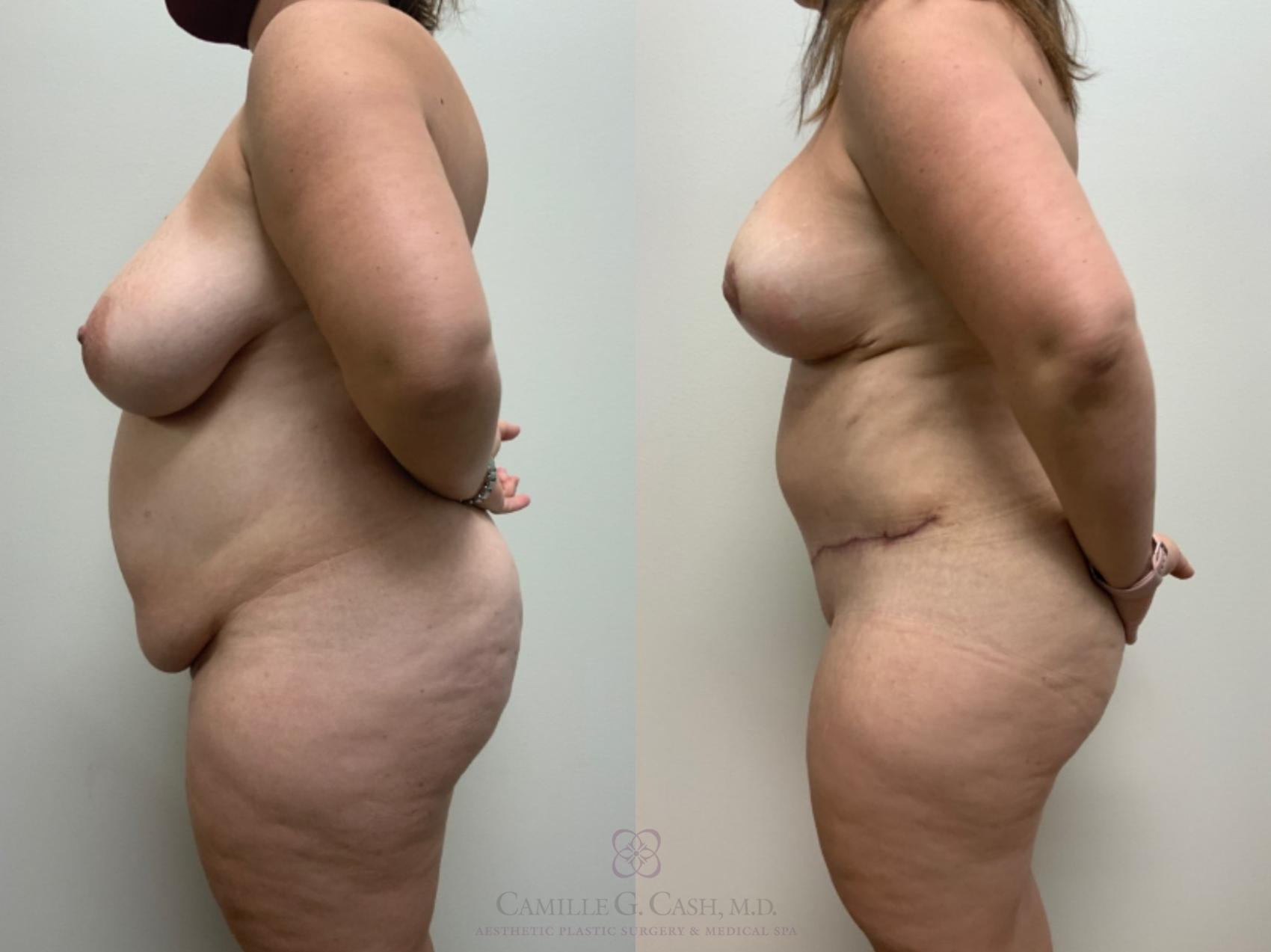 Before & After Mommy Makeover Case 498 Right Side View in Houston, TX