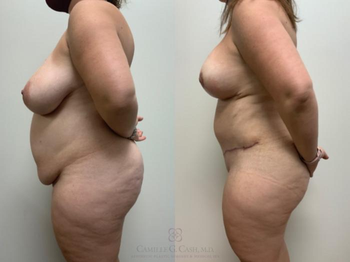 Before & After Tummy Tuck With Hernia Repair Case 498 Right Side View in Houston, TX