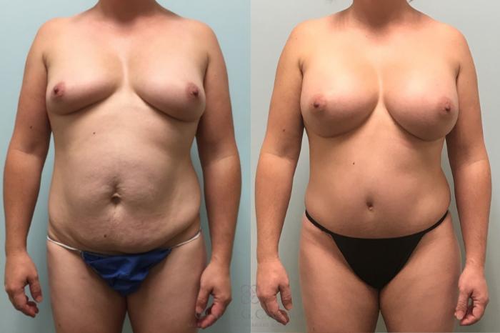 Before & After Breast Augmentation Case 519 Front View in Houston, TX