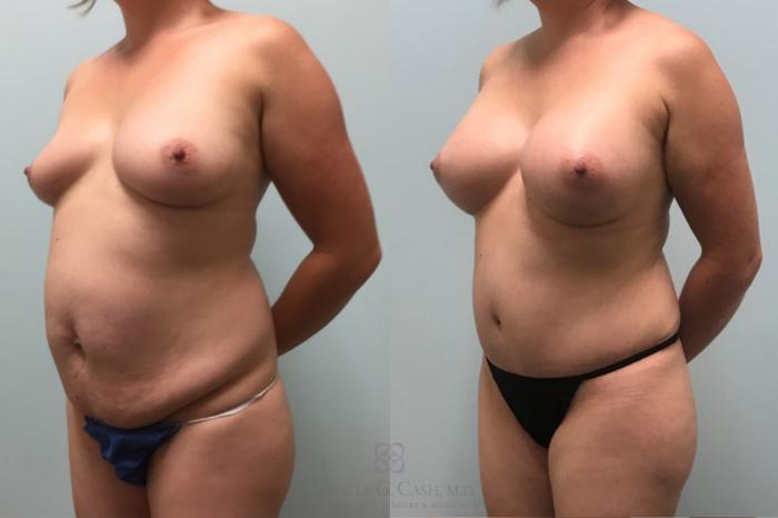 Before & After Breast Augmentation Case 519 Left Oblique View in Houston, TX