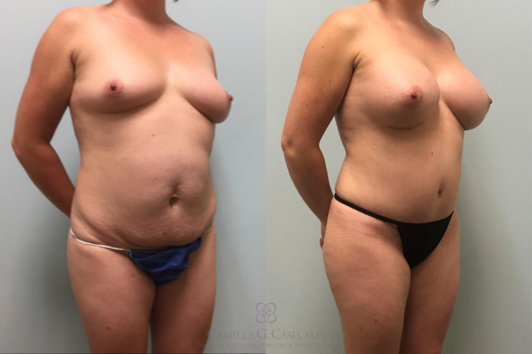Before & After Mommy Makeover Case 519 Right Oblique View in Houston, TX