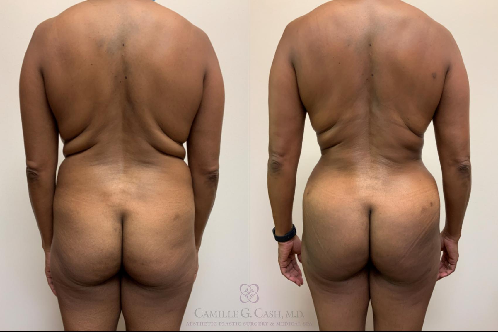 Before & After Mommy Makeover Case 521 Back View in Houston, TX