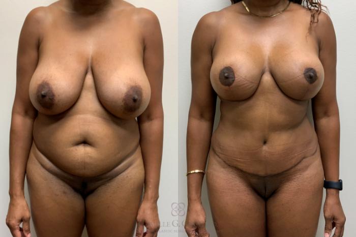 Before & After Mommy Makeover Case 521 front 8 months View in Houston, TX