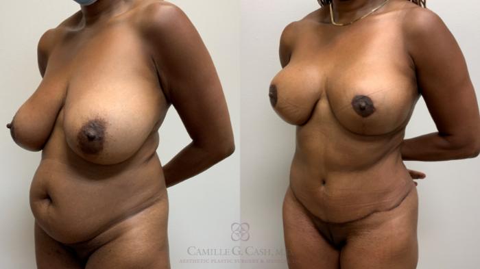 Before & After Mommy Makeover Case 521 Right Oblique View in Houston, TX