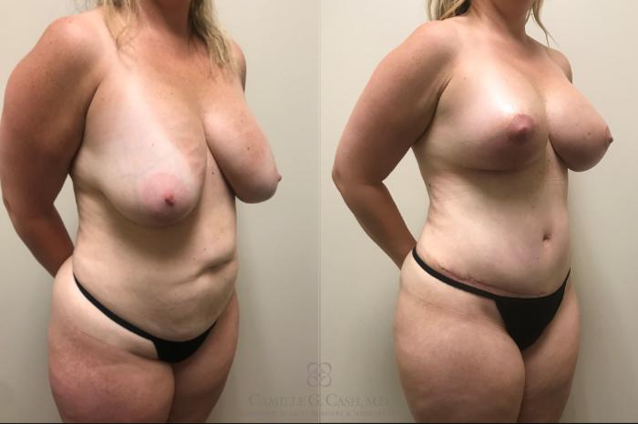 Before & After Mommy Makeover Case 523 Left Oblique View in Houston, TX