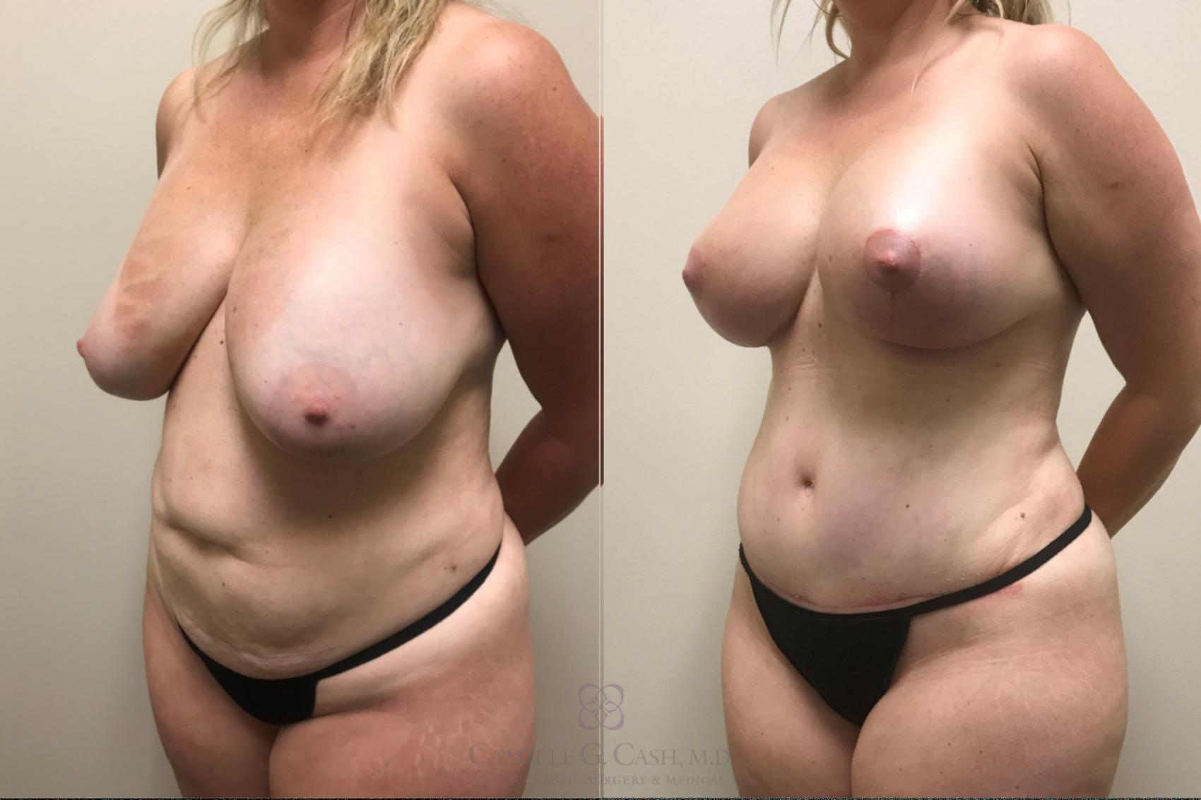 Before & After Mommy Makeover Case 523 Right Oblique View in Houston, TX