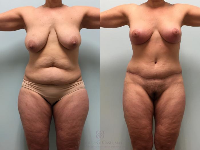 Before & After Mommy Makeover Case 525 front 6 weeks View in Houston, TX
