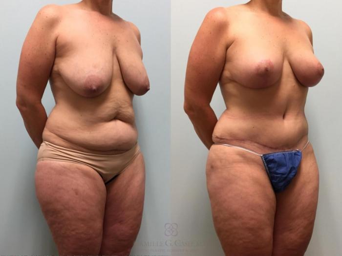 Before & After Mommy Makeover Case 525 Left Oblique View in Houston, TX