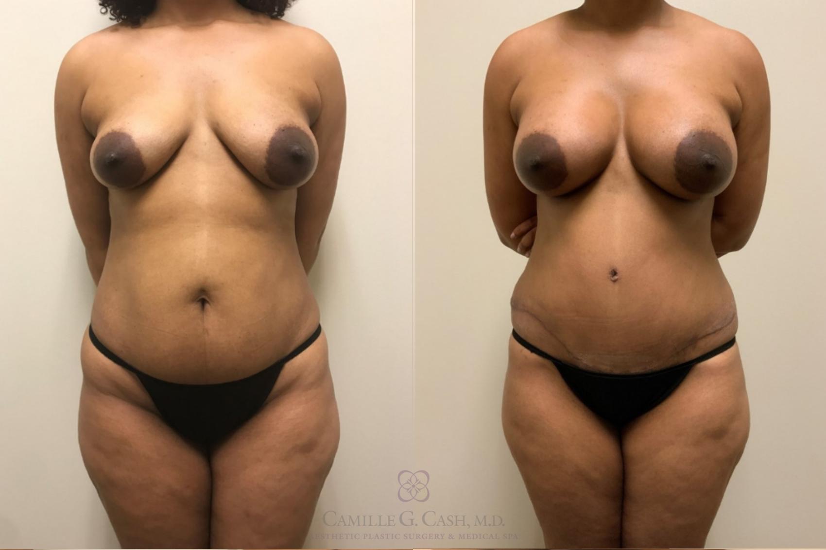 Before & After Mommy Makeover Case 534 6 weeks after front View in Houston, TX