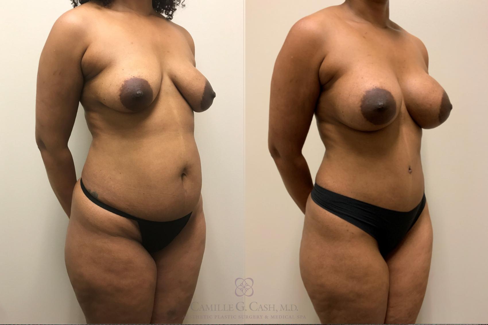 Before & After Mommy Makeover Case 534 Left Oblique View in Houston, TX