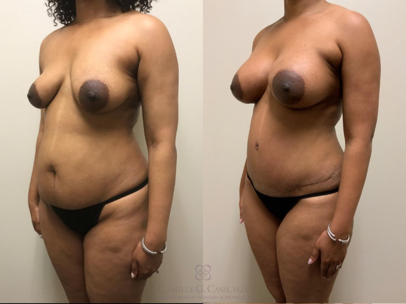 Before & After Mommy Makeover Case 534 Right Oblique View in Houston, TX