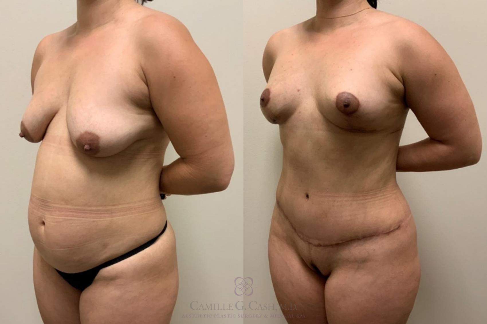 Before & After Mommy Makeover Case 548 Right Oblique View in Houston, TX